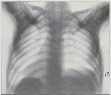 Chest X-ray showing the earliest lesions of pulmonary tuberculosis
